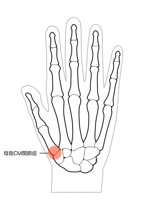 右手拇指|「母指CM関節症」｜日本整形外科学会 症状・病気をしらべ